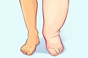 jambe plus gonflée plus enflée